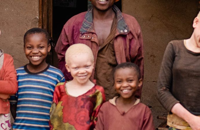 Challenges And Solutions To Albinism In Nigeria: A Call For Awareness, Protection, And Empowerment – OHI